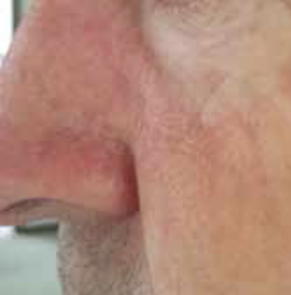 Rosacea After Treatment